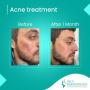 Acne treatment in Vancouver BC by Dr. Shehla Ebrahim