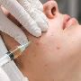 Acne Treatment in dubai