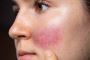 Soothing Your Skin: Rosacea Treatment Explained