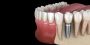 Dental Bone Grafts at Smile Again Dental Group