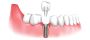Dental implants los angeles | Smile Again Dental Group