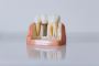 Dental Implants Van Nuys | Smile Again Dental Group