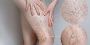 Are Varicose Vein Treatments Covered by Insurance? 