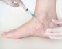 what is the treatment for varicose veins