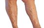How Much Does Varicose Vein Treatment Cost?