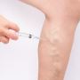 Are varicose veins covered by insurance?