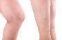 What are the Treatment Options for Varicose Veins?