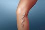 How Much Does Varicose Vein Treatment Cost?