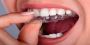 Straighten Your Teeth with Invisalign in Cardiff