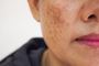 Laser Treatment for Pigmentation in Coimbatore