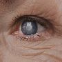 Cataract Surgery Solutions Tailored to Your Vision