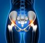 Best Place to Get Robotic Hip & Knee Replacement Surgery in 