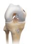 Best ACL Surgeon in Gurgaon