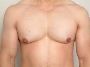 Male Breast Surgery in Delhi: Transformative Solutions for G
