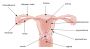 uterine fibroid removal 
