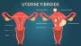 Different types of uterus