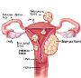 Pictures Of Fibroids
