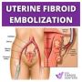 Uterine Fibroid Embolization (UFE) Procedure: Advanced Minim