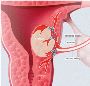 Uterine Fibroid Embolization (UFE) for Fibroids: A Minimally
