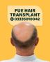  hair transplant procedures 