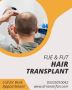 Hair transplant services in islamabad