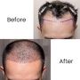 Hair Transplantation Treatment