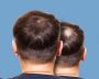Hair Transplant clinic in bangalore