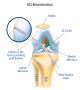 Your Knee Pain Head-On with Hamstring ACL Reconstruction