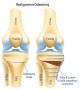 Move Pain-free with Osteotomy Surgery