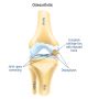 Effective Osteoarthritis Knee Treatment Options Available