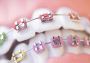 Get the Smile You Deserve with Braces in Tanjong Pagar