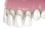 5 Amazing Benefits of Veneer Teeth