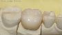 5 Tips for veneer teeth 