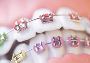 Thinking of getting braces for your teen? Here's how 