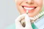 5 Advantages of Dental Veneer