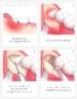 5 Measures for Extraction of Wisdom Tooth