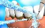 Scaling and Polishing / 7 Ways maintain clean teeth