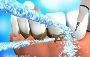 5 Ultimate benefits of dental scaling and polishing