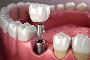 5 Amazing Benefits of Dental Implants