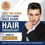 Affordable Hair Transplant Services In Chandigarh