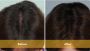 Stem Cell Therapy for Hair Restoration in West LA