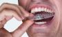 Orthodontic Treatment by the West Vaughan Dental
