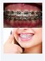 Conventional Braces Berwick - Woodleigh Waters Dental Surger