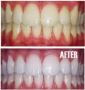Teeth Whitening Treatment Berwick