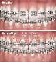 Get Your Teeth Straightened by Orthodontic Dental Treatment 