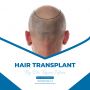 Hair transplant services Islamabad(pakistan)