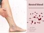 How to Treat a Busted Blood Vessel in Your Leg at Home 