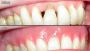 Gingival Mask Services
