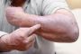Online Psoriasis Treatment - Fast and Convenient Access
