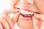 Online clear aligners Online clear aligners